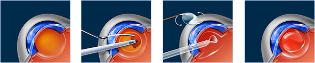 Cataract Surgery Diagram