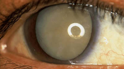 Eye with Cataract