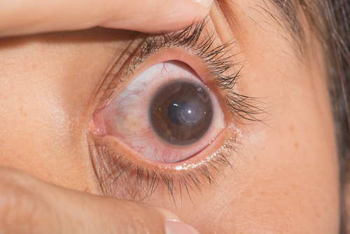 Corneal Ulcer