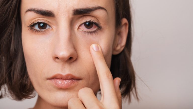 Do I Need to See My Eye Doctor if My Eye is Red?