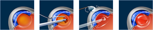 Cataract Surgery Diagram